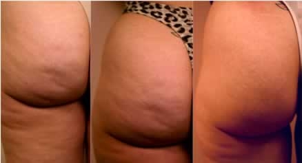 Cellulite Remover Massage Gloves ขัดเซลลูไลท์ออกในพริบตา รูปที่ 2