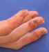 รูปย่อ จำหน่ายสารสกัดจากสมุนไพรธรรมชาติป้องกัน รักษาอาการผิวหนังอักเสบตุ่มคันแบบใส(Dermatitis dyshidrosis)  รูปที่4