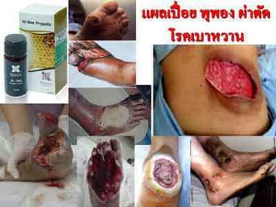 ไฮ-บี โปรพอลิส ( Hi-Bee propolis ) แก้ปัญหาแผลเน่าจากโรคเบาหวาน รูปที่ 3