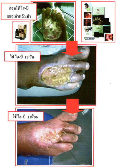 ไฮ-บี โปรพอลิส ( Hi-Bee propolis ) แก้ปัญหาแผลเน่าจากโรคเบาหวาน รูปที่ 6