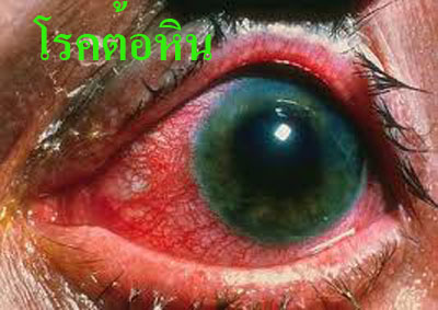 ไฮ-มาริโกลด์ พลัส ( Hi-Marigold ) ป้องกันต้อกระจก ต้อหิน รูปที่ 6