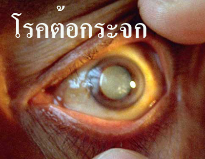 ไฮ-มาริโกลด์ พลัส ( Hi-Marigold ) ป้องกันต้อกระจก ต้อหิน รูปที่ 5