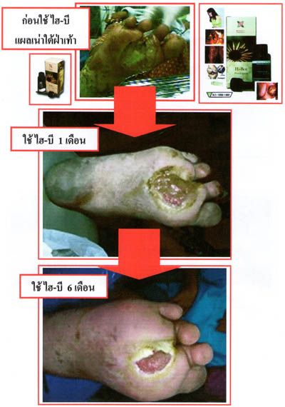ไฮ-บี โปรพอลิส ( Hi-Bee propolis ) แก้ปัญหาแผลเน่าจากโรคเบาหวาน รูปที่ 5