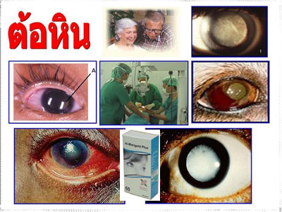 ไฮ-มาริโกลด์ พลัส ( Hi-Marigold ) ป้องกันต้อกระจก ต้อหิน รูปที่ 3
