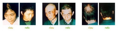 แฮรี่โกว์ ( Haregrow ) ผลิตภัณฑ์บำรุงรากผม เพื่อผมใหม่ที่แข็งแรง ผลงานวิจัยล่าสุดที่รับรองคุณภาพโดย ศาสตราจารย์ ดร.ยาง  รูปที่ 4