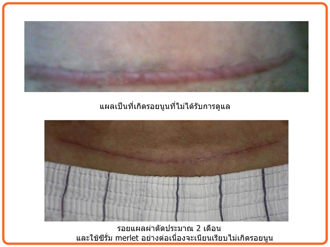 Merlet Skintherapy serum ลดรอยแผลเป็นและแผลผ่าตัดอย่างได้ผลว่าไม่นูน รูปที่ 3