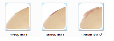 Merlet Skintherapy serum ลดรอยแผลเป็นและแผลผ่าตัดอย่างได้ผลว่าไม่นูน รูปที่ 2
