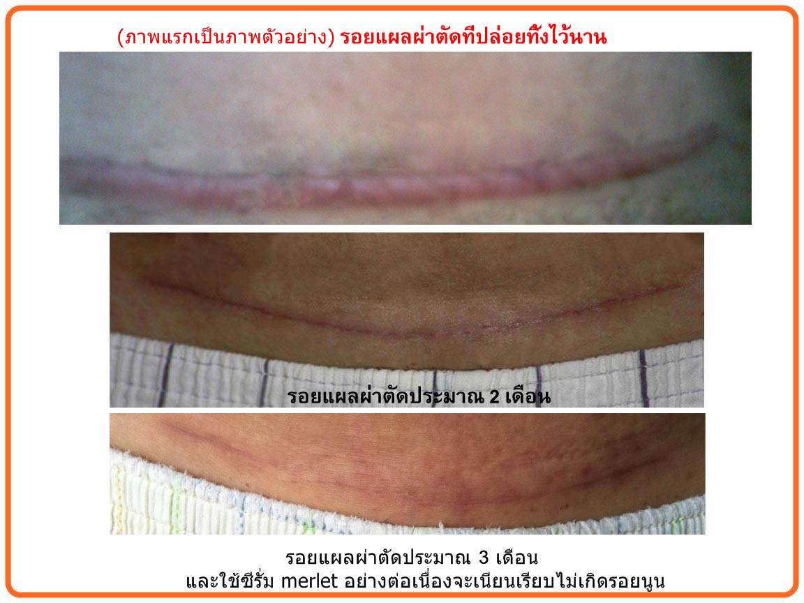 Merlet Skintherapy serum ลดรอยแผลเป็นและแผลผ่าตัดอย่างได้ผลว่าไม่นูน รูปที่ 4