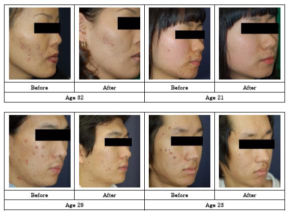 สบู่อีฟสโกเรีย/Kalos Scoria Soap ช่วยแก้ปัญหาเรื่องสิวต่างๆ ลดรอยดำ เพื่อผิวกระจ่างใส รูปที่ 3