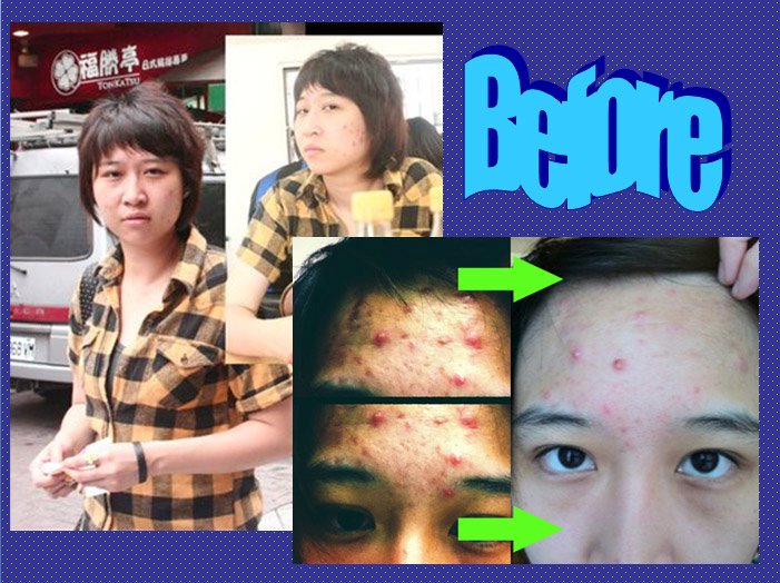 สบู่อีฟสโกเรีย/Kalos Scoria Soap ช่วยแก้ปัญหาเรื่องสิวต่างๆ ลดรอยดำ เพื่อผิวกระจ่างใส รูปที่ 4