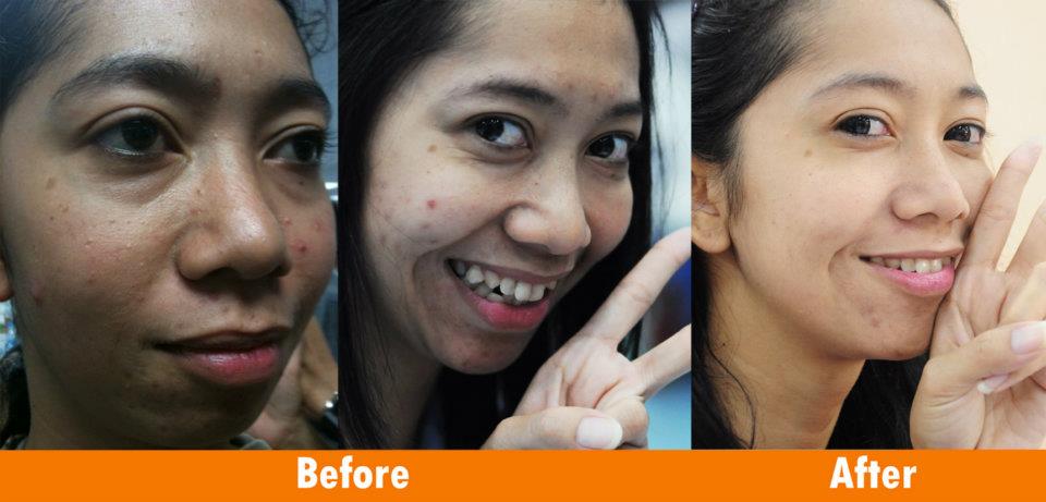 สบู่อีฟสโกเรีย/Kalos Scoria Soap ช่วยแก้ปัญหาเรื่องสิวต่างๆ ลดรอยดำ เพื่อผิวกระจ่างใส รูปที่ 5