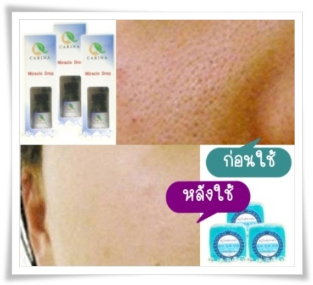 Miracle drop ร่วมกับสบู่วิทย์ฮาเซล ช่วยกระชับรูขุมขน ลดความมัน หมดปัญหารูขุมขนกว้าง   รูปที่ 1