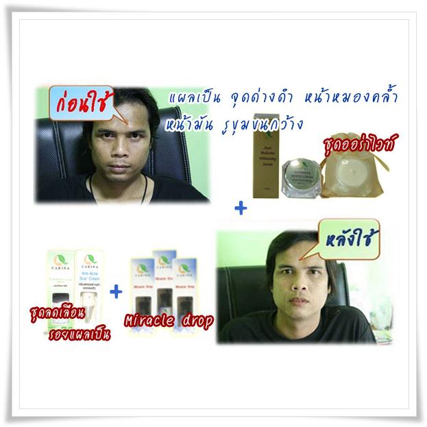 เซตลดรอยแผลเป็นจากสิว ด้วย BHA และ Acne Scar Cream ลดสิว ลดแผลเป็นจุดด่างดำ  รูปที่ 1