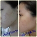 รูปย่อ Anti -Acne:เซตลดสิว กำจัดสิว ที่ดีที่สุด ถูกและดี รายระเอียดพร้อม รีวิว อ่าน>>>>> รูปที่7