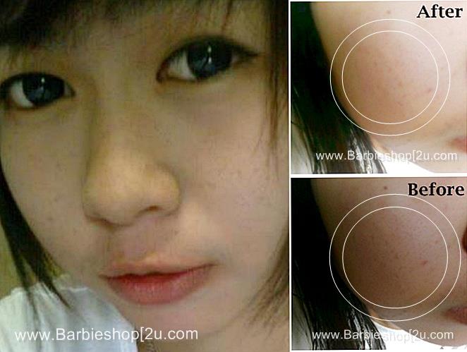 Anti -Acne:เซตลดสิว กำจัดสิว ที่ดีที่สุด ถูกและดี รายระเอียดพร้อม รีวิว อ่าน>>>>> รูปที่ 1