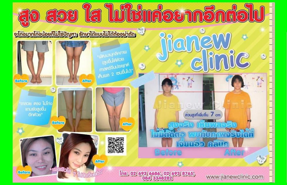 อยากสูง เพิ่มความสูง ขายาวไม่เท่ากัน ขาสั้น ขาแบะ ขาแปร อกไก่ ลำตัวบิดเบี้ยว ลดน้ำหนักเฉพาะส่วนเห็นผล100%(ไม่มีโยโย่) รูปที่ 3