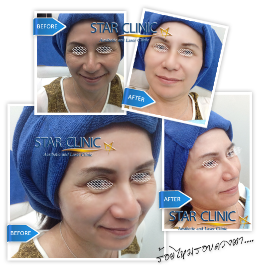 พิเศษ0%  Vaser เสริมจมูก เสริมหน้าอก @Star Clinic งามวงศ์วาน รูปที่ 1