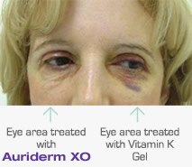 Auriderm XO CREAM หมดปัญหาเรื่องรอยช้ำยาวนานจากการศัลยกรรม รูปที่ 4