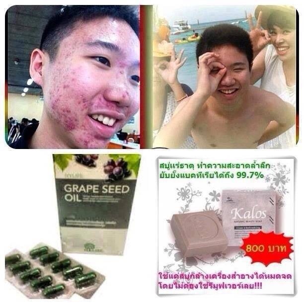 เกรปซีดออยด์  รูปที่ 2