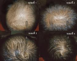ยาปลูกผม Nu Hair รูปที่ 4