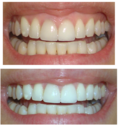 จำหน่าย Crest 3D White WhiteStrips แผ่นฟอกฟันขาว