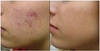 รูปย่อ 5D White Perfect Treatment and Anti acne รูปที่5