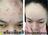 รูปย่อ ส่ง EMS ฟรี ทุกออเดอร์ Skincare by anya ครีมบล็อคสิว ปราบสิว หน้าขาวใสไร้รอยดำได้อย่างปลอดภัย รีวิวเพียบ ราคาถูก มีสินค้ รูปที่3