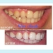 รูปย่อ New smile" ชุดฟอกสีฟัน สามารถทำเองได้ที่บ้าน ทำให้สีฟันขาวสะอาดขึ้น เพิ่มความมั่นใจในการยิ้ม เสริมสร้างบุคลิกที่ดีควรใช้อาทิตย์ละ3ครั้ง รูปที่2