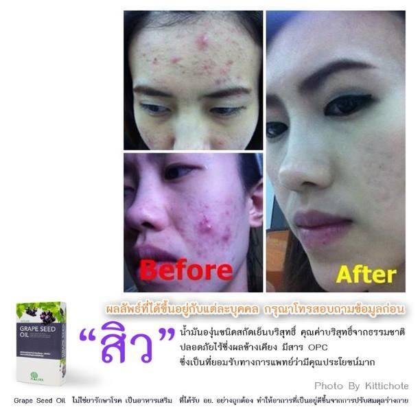 Grape Seed Oill  น้ำมันองุ่น ชนิดสกัดเย็น รูปที่ 6