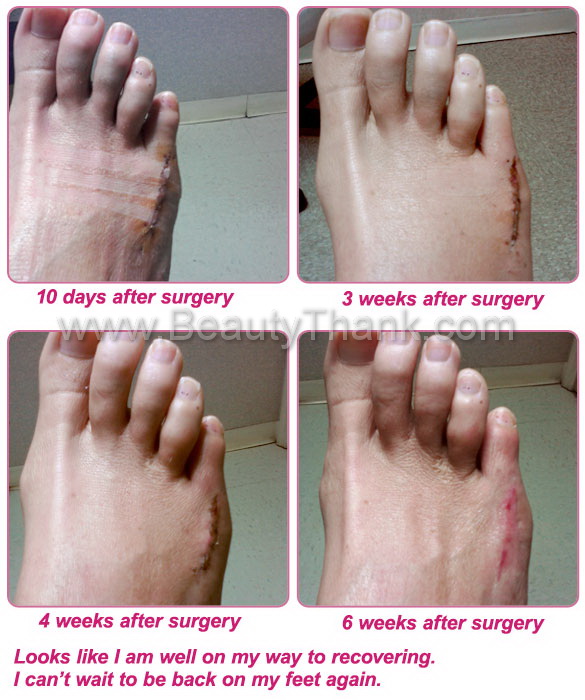 อุปกรณ์บรรเทาอาการปวดนิ้วเท้า Good Night Bunion  รูปที่ 4