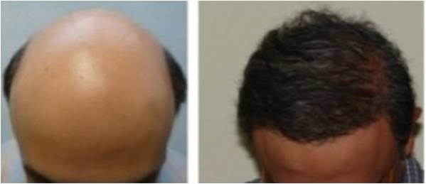  Affordable Hair transplant surgery Thailand can restore your naturally growing hair for life รูปที่ 1