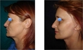 Facelift in Thailand Rhytidectomy - Urban Beauty Thailand