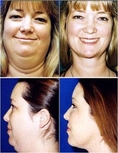  Get Gorgeous Now with Facial Liposuction - Urban Beauty Thailand