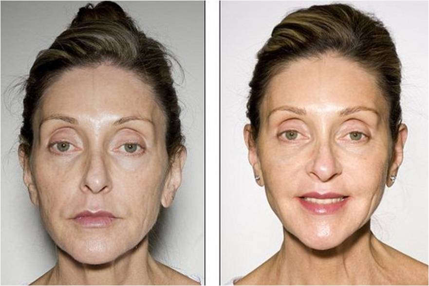 Fat Grafting Fat transfer Thailand - Urban Beauty Thaialnd รูปที่ 1