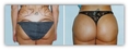 www.urbanbeautythailand.com - Brazilian Butt Lift Thailand Stem Cell Fat Graft Butt Lift Bangkok
