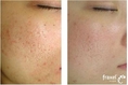 Melasma, Pigment treatment, Acne Scar, Tattoo Removal, Fraxel Medlite laser