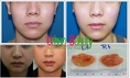  Buccal fat extraction Thailand - Urban Beauty Thailand