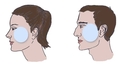 Cheek Implantation Thailand - Urban Beauty Thailand
