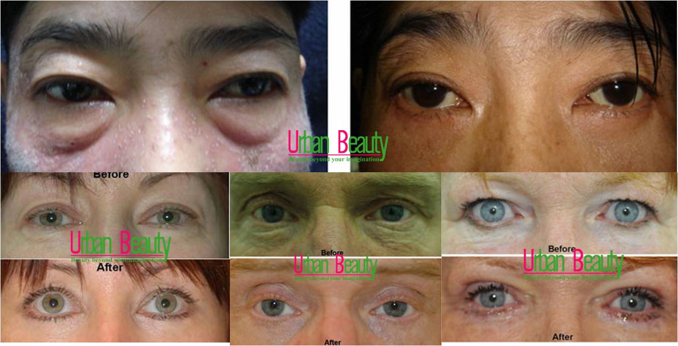  Blepharoplasty Thailand - Urban Beauty Thailand รูปที่ 1