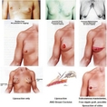  www.urbanbeautythailand.com - Male Breast Reduction, Gynecomastia Thailand Excellent Reputation &100% Satisfaction Rate