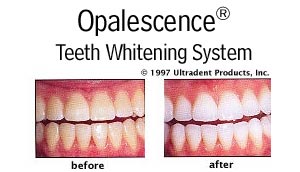 opalescence20% ของแท้ นำเข้าจาก USA จำนวน 4 หลอด  รูปที่ 7