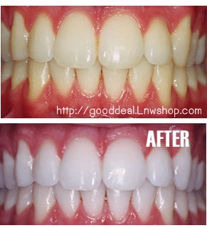 opalescence20% ของแท้ นำเข้าจาก USA จำนวน 4 หลอด  รูปที่ 3