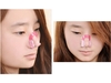 รูปย่อ ที่หนีบจมูก NOSE UPของแท้100% ราคาส่ง 38 บาท รูปที่5