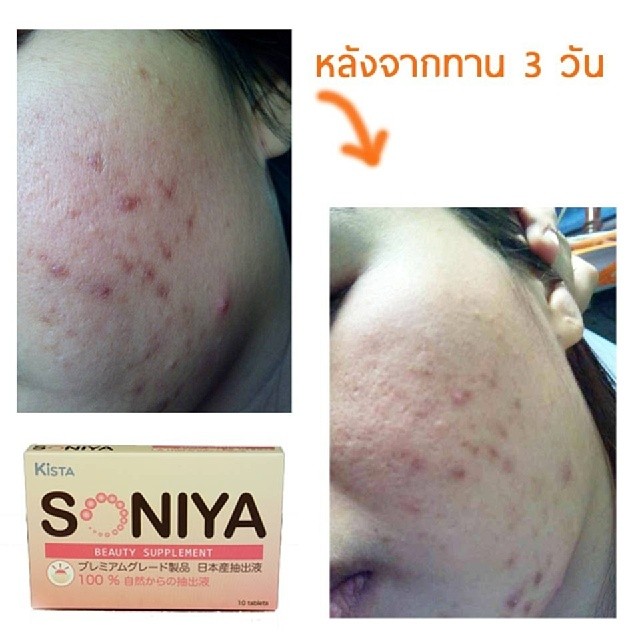 Soniya เกิดมาเพื่อฆ่าสิว รูปที่ 2