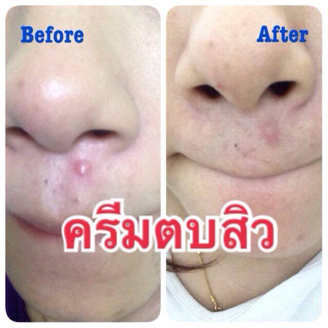 ครีมตบสิว Anti – Acne Massaging Cream รูปที่ 6