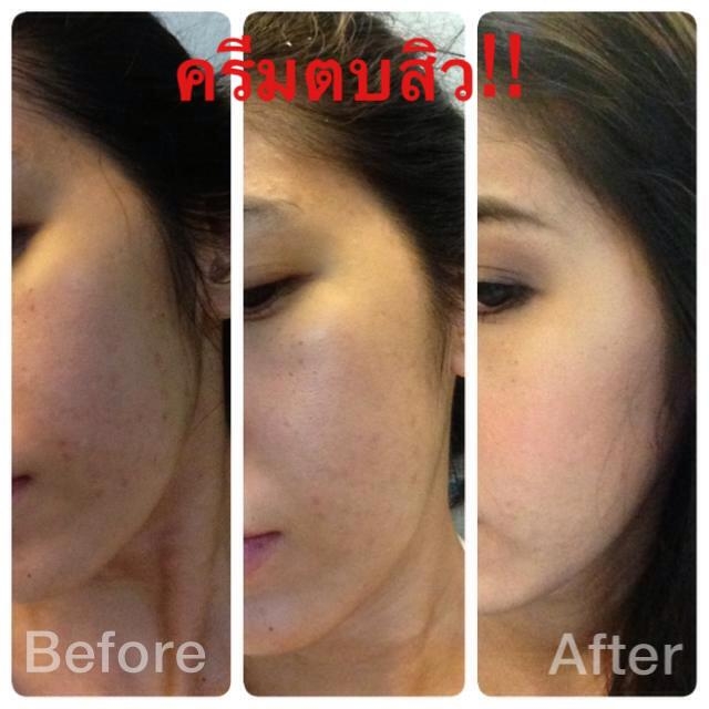 ครีมตบสิว Anti – Acne Massaging Cream รูปที่ 7