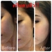 รูปย่อ ครีมตบสิว Anti – Acne Massaging Cream รูปที่7