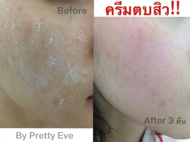 ครีมตบสิว Anti – Acne Massaging Cream รูปที่ 3