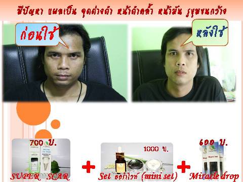 แผลเป็น จุดด่างดำ แลดูจางลง หน้าขาวใส ภายใน 2 อาทิตย์ ด้วยชุดลดเลือนรอยแผลเป็นชุดนี้ค่ะ รูปที่ 3