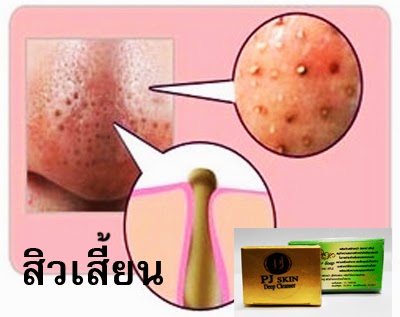 สิวอุดตัน แก้ปัญหาด้วย สบู่พีเจ สกิน ดีพ คลีนเซอร์  รูปที่ 2